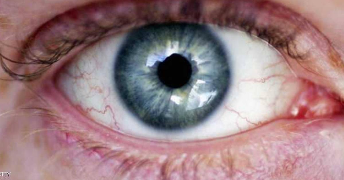 شبكية "الخلايا الجذعية".. أمل جديد للمصابين بالعمى