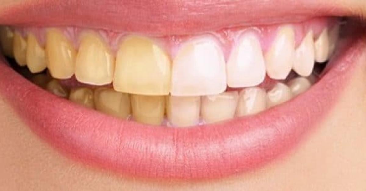وصفة سحرية لعلاج اصفرار الاسنان