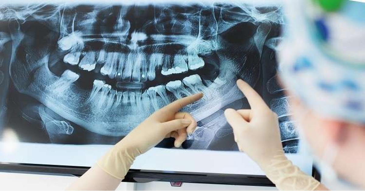سبب مرض ألزهايمر قد يعيش داخل فمك