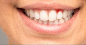 هل يؤثر خروج الدم من الفم على الصوم؟