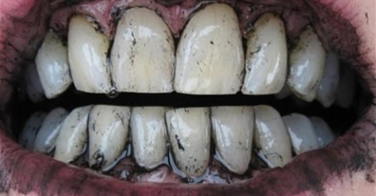 احذر .. الفحم خطر جدًا على الأسنان