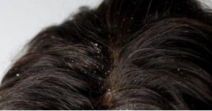 هل تُسبب قشرة الرأس تساقط الشعر؟